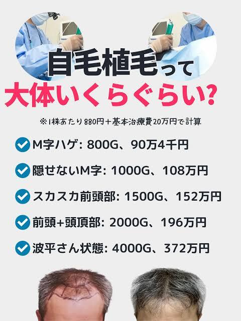 【ハゲ悲報】植毛、めちゃくちゃ金が掛かることが判明・・・・・・・