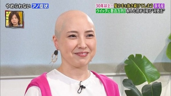 画像 髪の毛を抜くことをやめられない抜毛症の女性 なんjクエスト