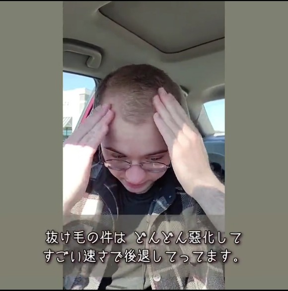 【画像】　男性ホルモンを投与した女の子、頭髪が薄くなりガチで後悔する・・・