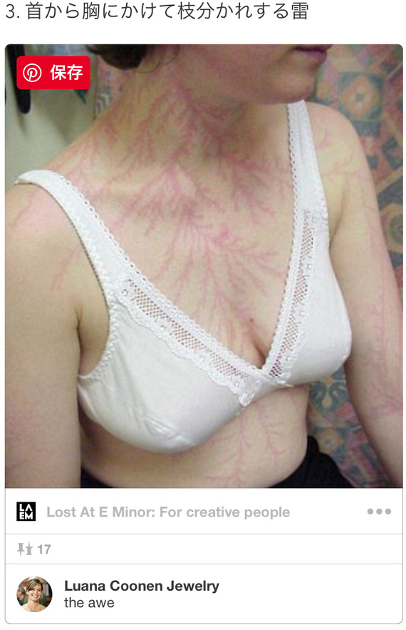 【激震】落雷から生還した人間さん達の体がヤバすぎると話題に・・・(画像あり)