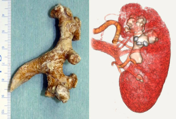 【悲報】　俺の腎臓が宝石作っててワロタｗｗｗｗｗｗｗｗｗｗｗｗ