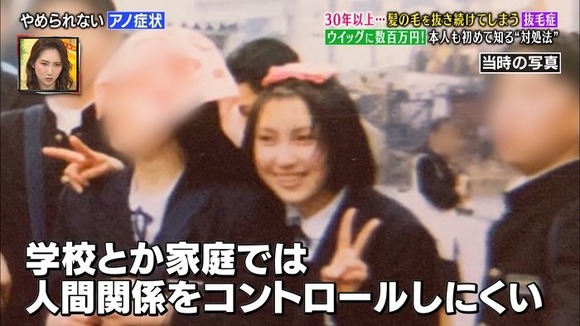 画像 髪の毛を抜くことをやめられない抜毛症の女性 なんjクエスト