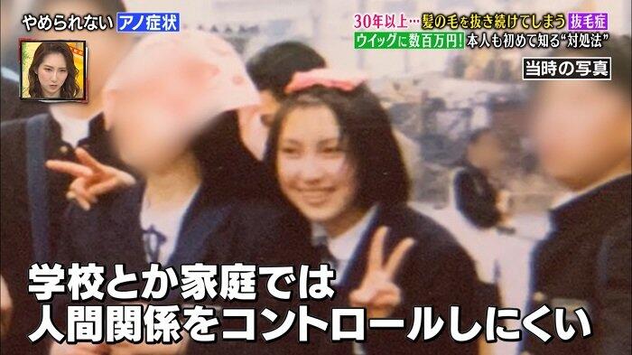 画像 髪の毛を抜くことをやめられない抜毛症の女性 なんjクエスト 画像 髪の毛を抜くことをやめられない抜毛症の女性 なんjクエスト
