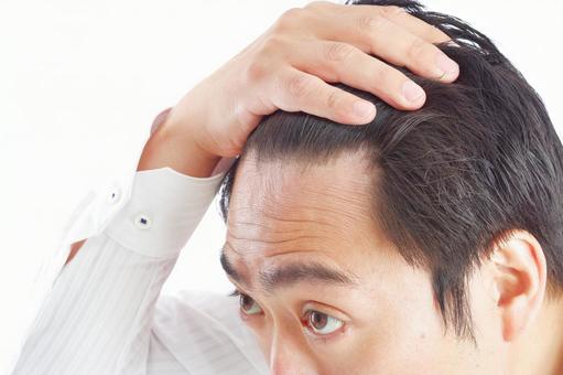 【画像】この毛量がハゲかハゲじゃないかネット上で議論になるｗｗｗｗｗｗｗｗｗｗｗｗｗｗｗｗ