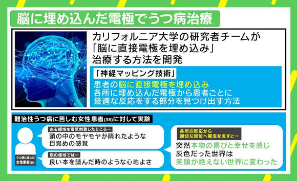 画像あり うつ病患者 死にたい 医者 はいはい 脳に電極ね なんjクエスト