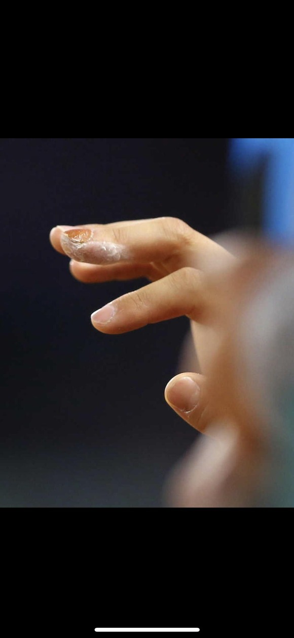 【画像】大谷翔平の爪、思ったよりとんでもない事になってたｗｗｗｗｗｗｗｗ