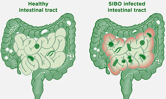 SIBO-imsge--1440x720