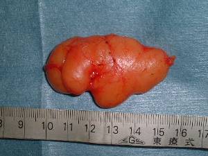 背中のしこり ドルフィンdcのひとりごと