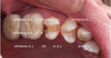 インレー 詰め物 の金属色が透けて黒くなる だけではない Dr イチローのホップ ステップ ジャンプ インレー 詰め物 の金属色が透けて黒くなる だけではない Dr イチローのホップ ステップ ジャンプ