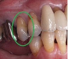 歯と歯の間の虫歯と 銀歯による歯の変色 Dr イチローのホップ ステップ ジャンプ