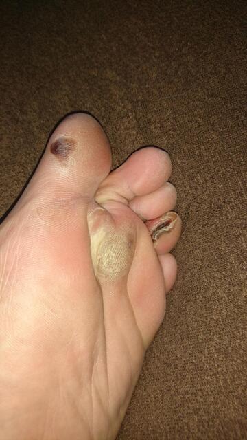 足の裏の角質がカチカチでハサミで切れるんだけど仲間いる 鈴木さん速報