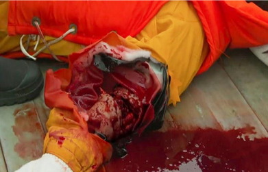 沢井の腕は無残にも・・