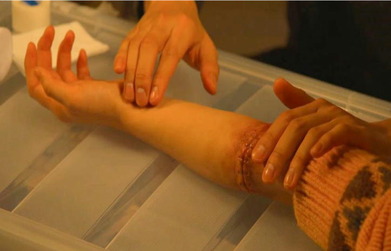 縫合した痕をみる