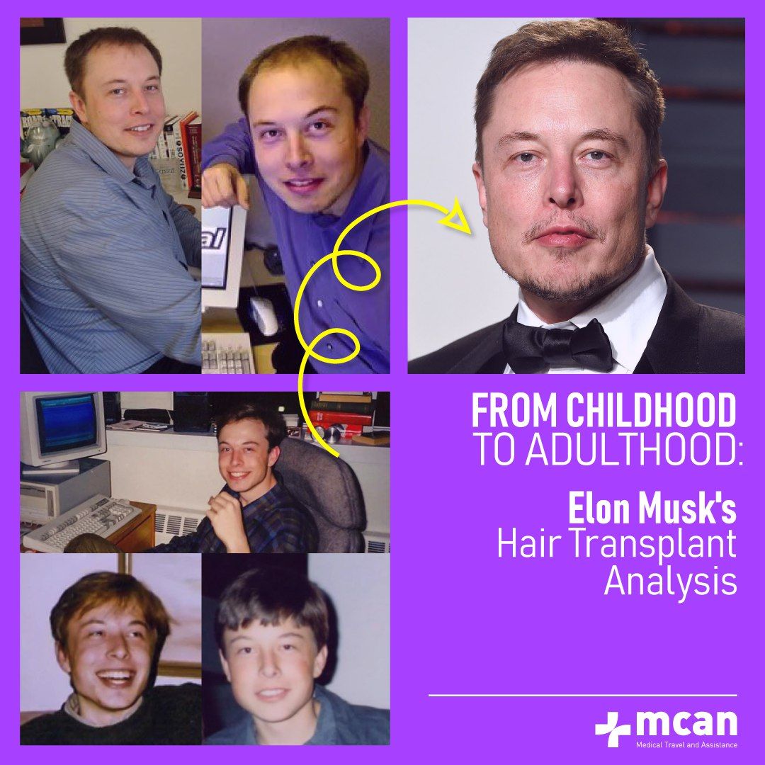 Маск волос. Элон Маск волосы. Элон Маск до пластики. Elon Musk hair transplant. Илон Маск волосы.