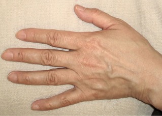 手に年齢を感じたら ヒアルロン酸でふっくらと若々しい手に Dr Fumiの美容blog