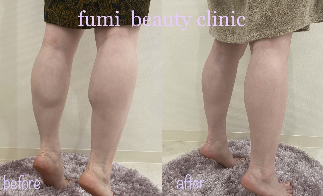 脚痩せボトックス Dr Fumiの美容blog