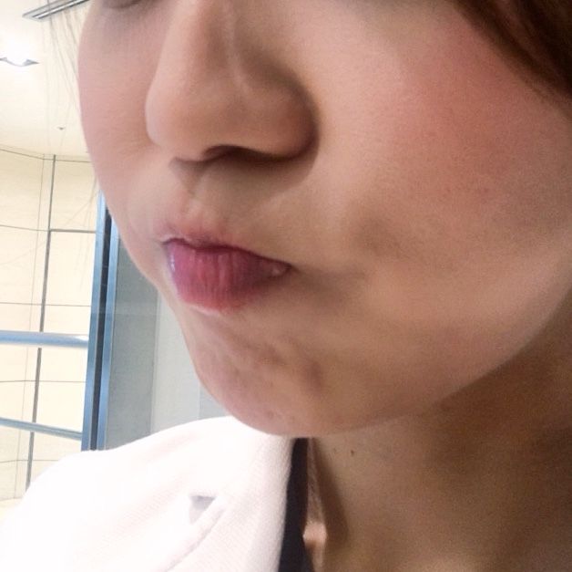 あごボトックスと首ボトックスをしました Dr Fumiの美容blog あごボトックスと首ボトックスをしました Dr Fumiの美容blog
