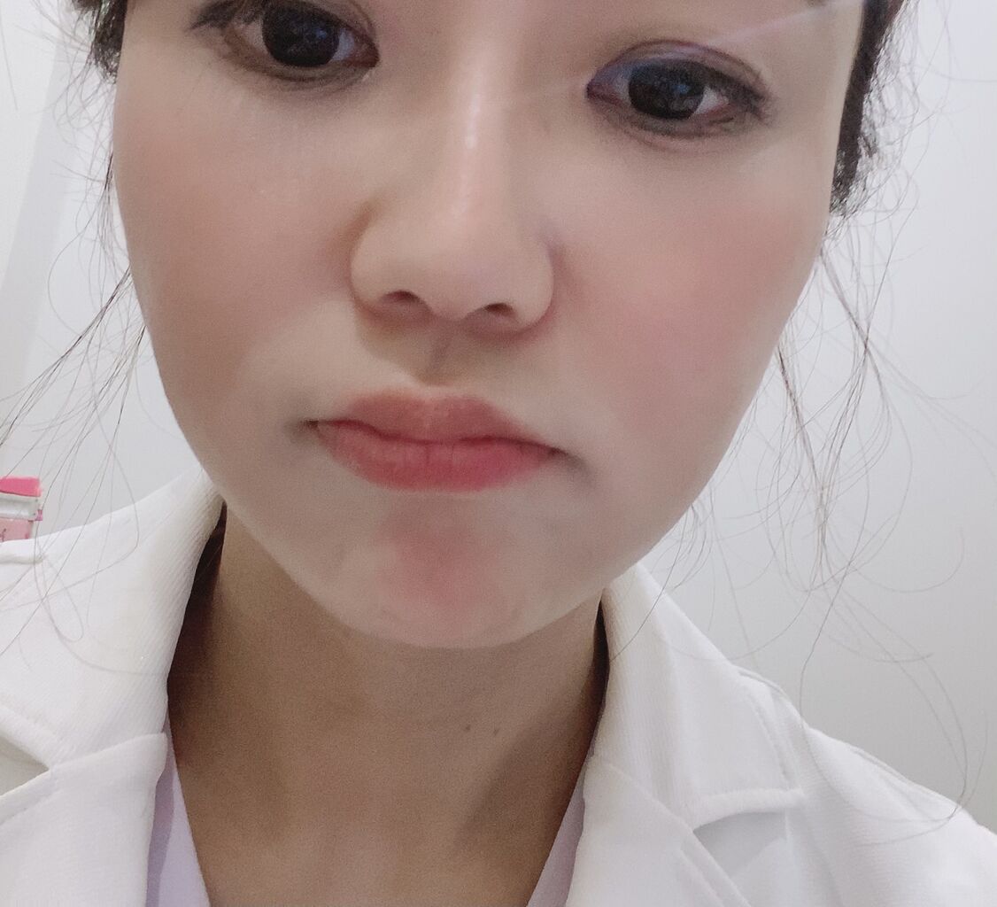 あごと口角のボトックスが完全に切れて Dr Fumiの美容blog あごと口角のボトックスが完全に切れて Dr Fumiの美容blog