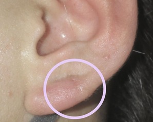 ピアスケロイド Dr Fumiの美容blog