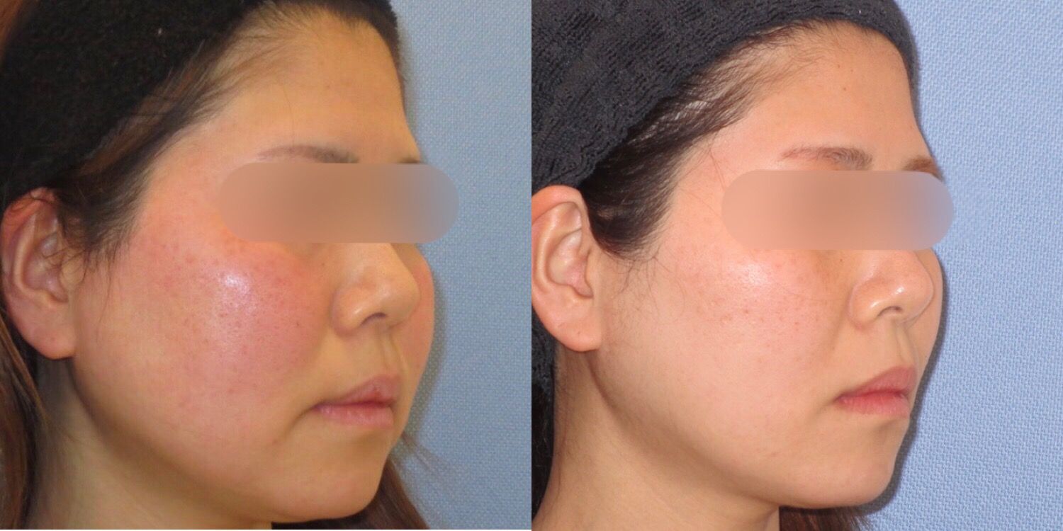 脂肪分解注射と糸のコンビネーションで小顔に Dr Fumiの美容blog