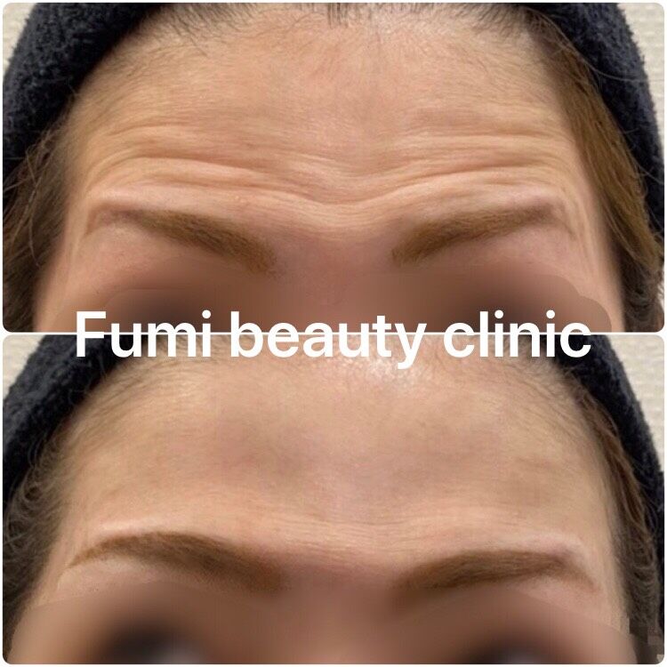 ボトックスの経過 眉間 額 鼻 Dr Fumiの美容blog