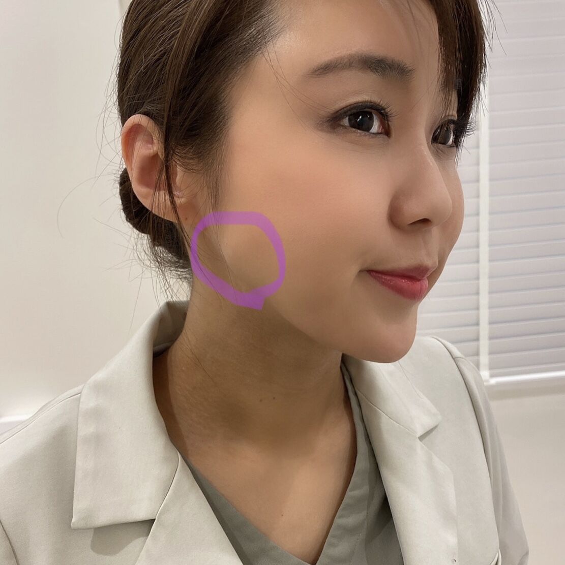 エラボトックス Dr Fumiの美容blog エラボトックス Dr Fumiの美容blog