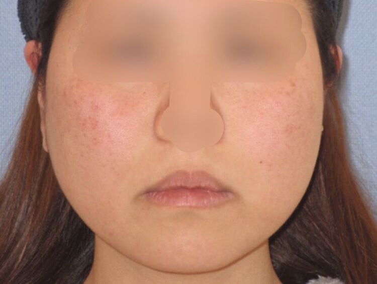 脂肪分解注射の経過 注射でだんだん小顔に Dr Fumiの美容blog 脂肪分解注射の経過 注射でだんだん小顔に Dr Fumiの美容blog