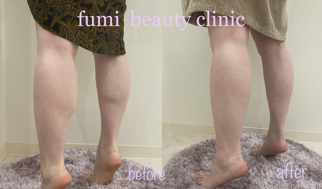 脚痩せボトックス Dr Fumiの美容blog