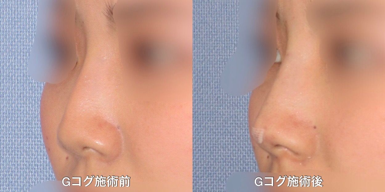 Gコグノーズで綺麗な鼻 鼻筋と鼻先の形の改善に Dr Fumiの美容blog