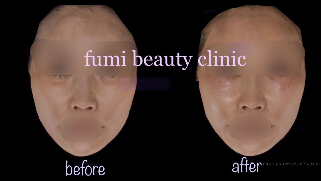 目の下のくぼみにsunekos スネコス Dr Fumiの美容blog