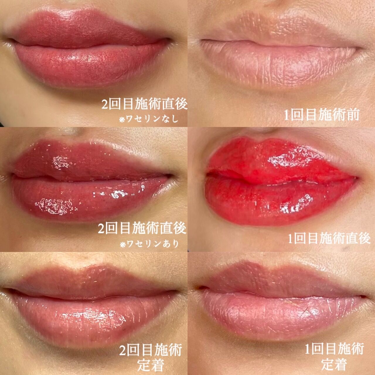リップアートメイク経過 ほくろのアートメイク Dr Fumiの美容blog