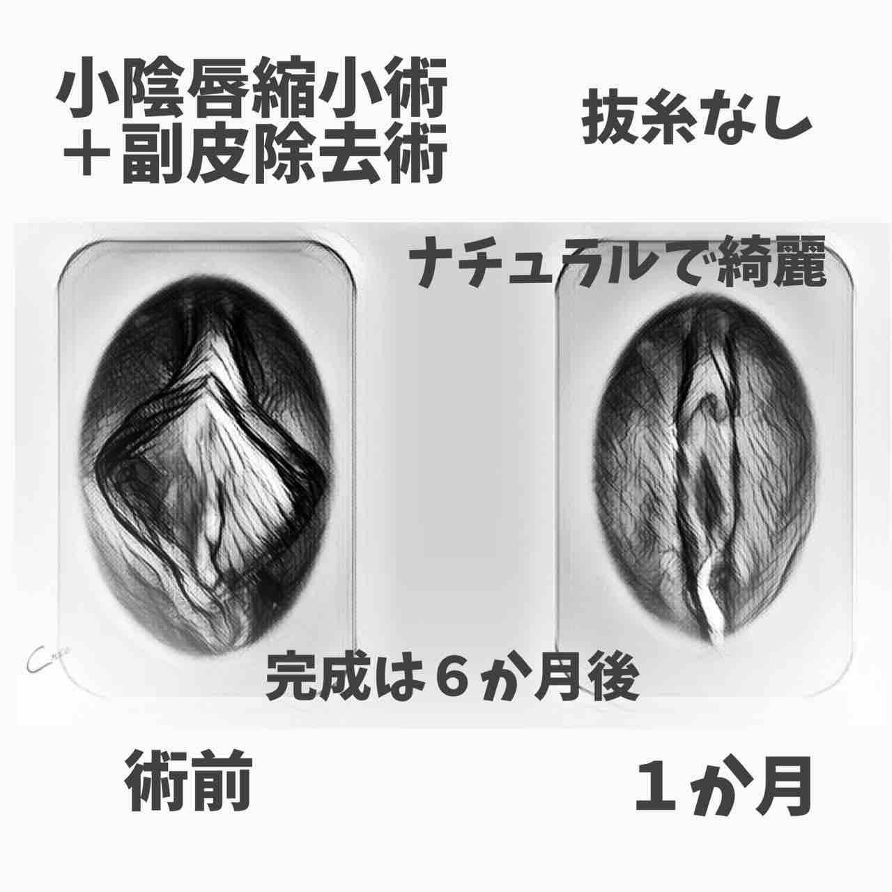 両側小陰唇縮小術 両側副皮除去術症例写真イラスト化 教えて藤田先生 女性器のお悩み 婦人科形成とは