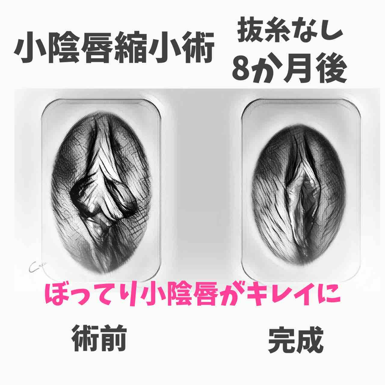 小陰唇縮小術の症例写真イラスト化 教えて藤田先生 女性器のお悩み 婦人科形成とは