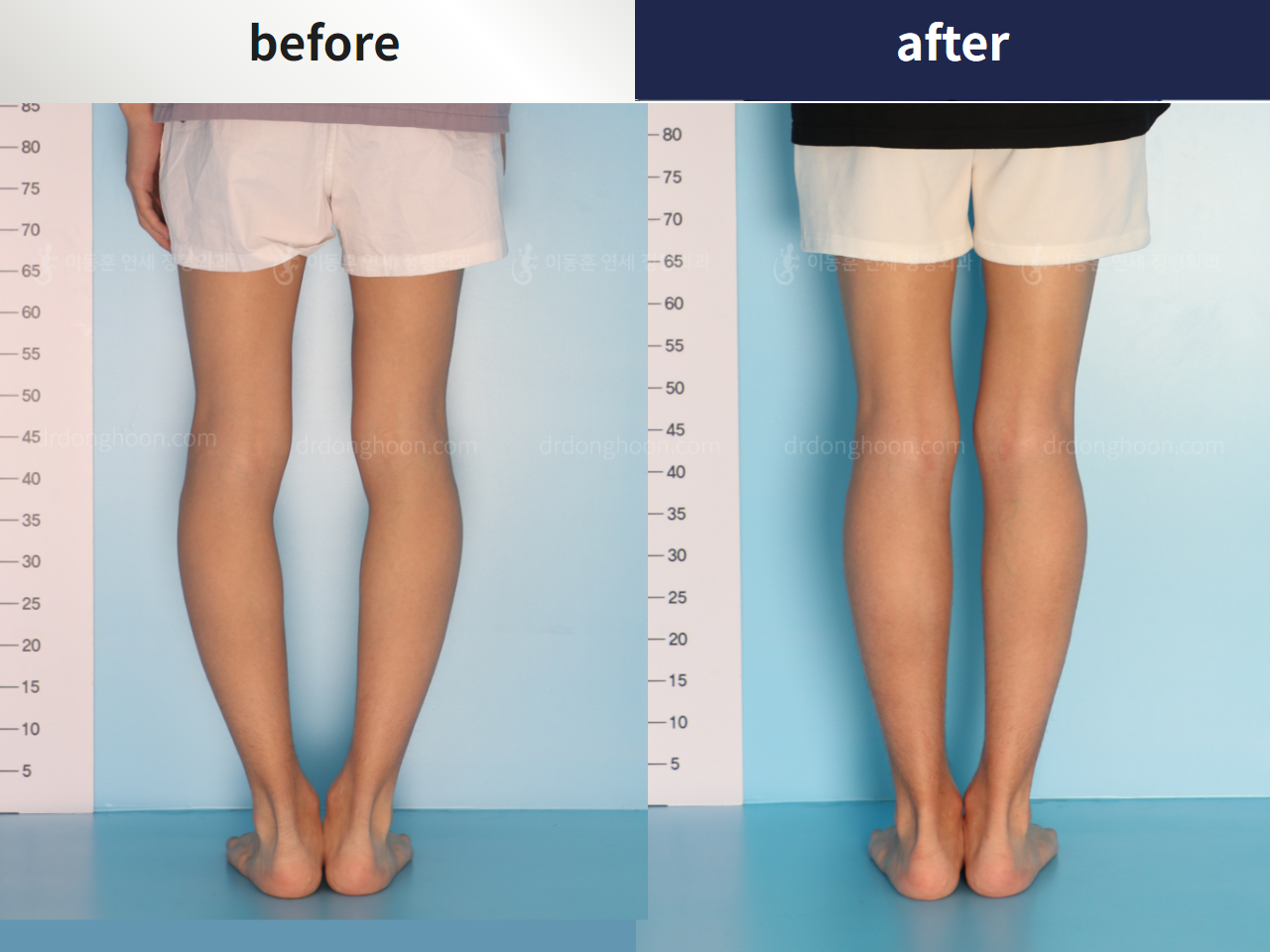 ｏ脚 回転変形 角変形 複合変形 のビフォーアフター写真 Dr Donghoonのブログ