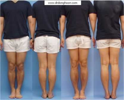 身長手術 身長を伸ばす手術 2 Dr Donghoonのブログ