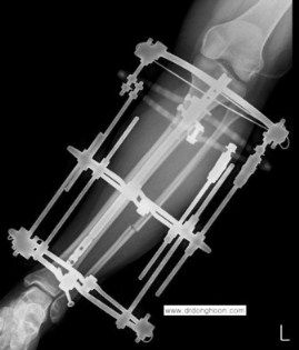 骨延長手術の際、イリザロフ(創外固定器)のピンの個数に関して : Dr. Donghoonのブログ