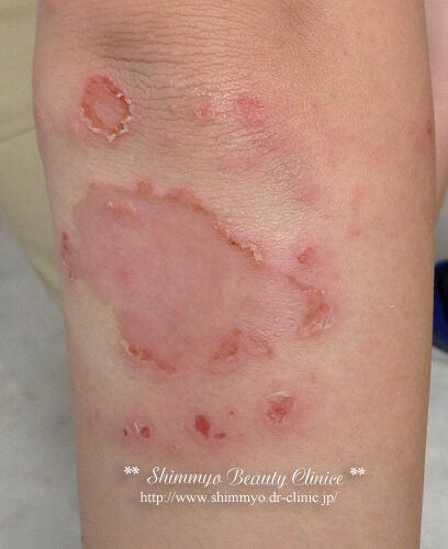 impetigo_2021L