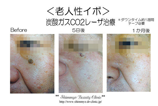 3枚CO2レーザートSK_BeforeAfter