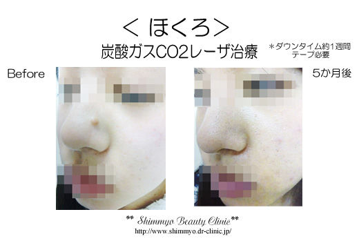 2枚CO2レーザート_PNBeforeAfter
