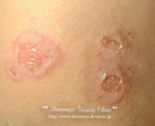 impetigo_CL