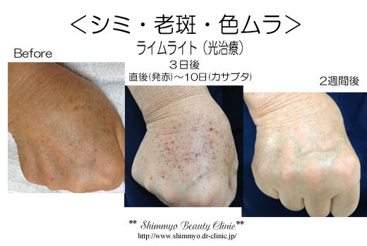 Dr Noriko S つぶやき Diary 院長日記 ライムライトで顔 手背のシミをリセット 症例