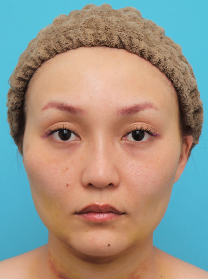 頬骨削り エラボトックス注射で輪郭を整えた30代女性の経過画像です 高須クリニック高須幹弥の美容整形症例画像写真集 頬骨削り エラボトックス注射で輪郭を整えた30代女性の経過画像です 高須クリニック高須幹弥の美容整形症例画像写真集