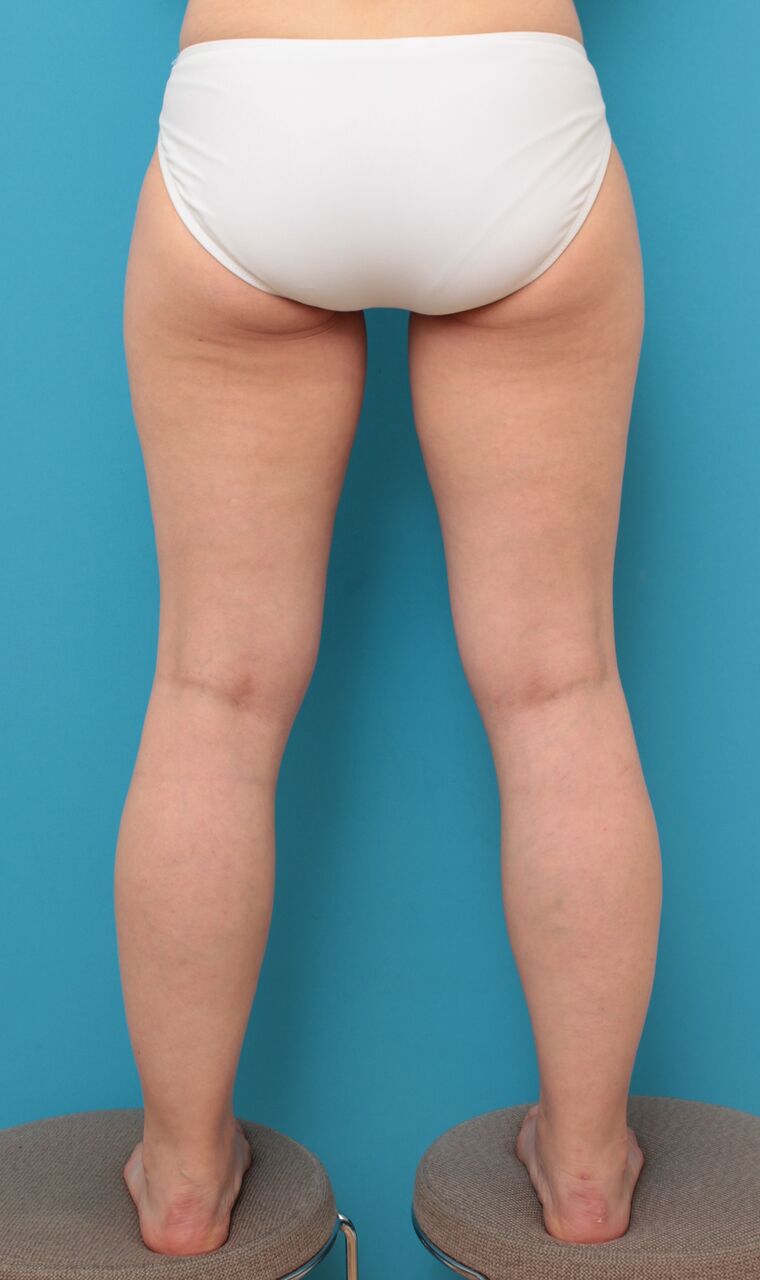 先日アップした 太もも全体とふくらはぎの脂肪吸引をした40代女性の症例写真の解説です 高須クリニック高須幹弥の美容整形症例画像写真集