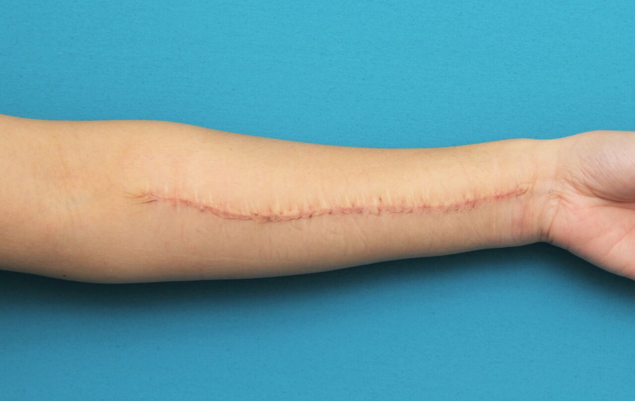 リストカットの傷跡を2回に分けて切除縫合手術した症例の経過画像です 高須クリニック高須幹弥の美容整形症例画像写真集