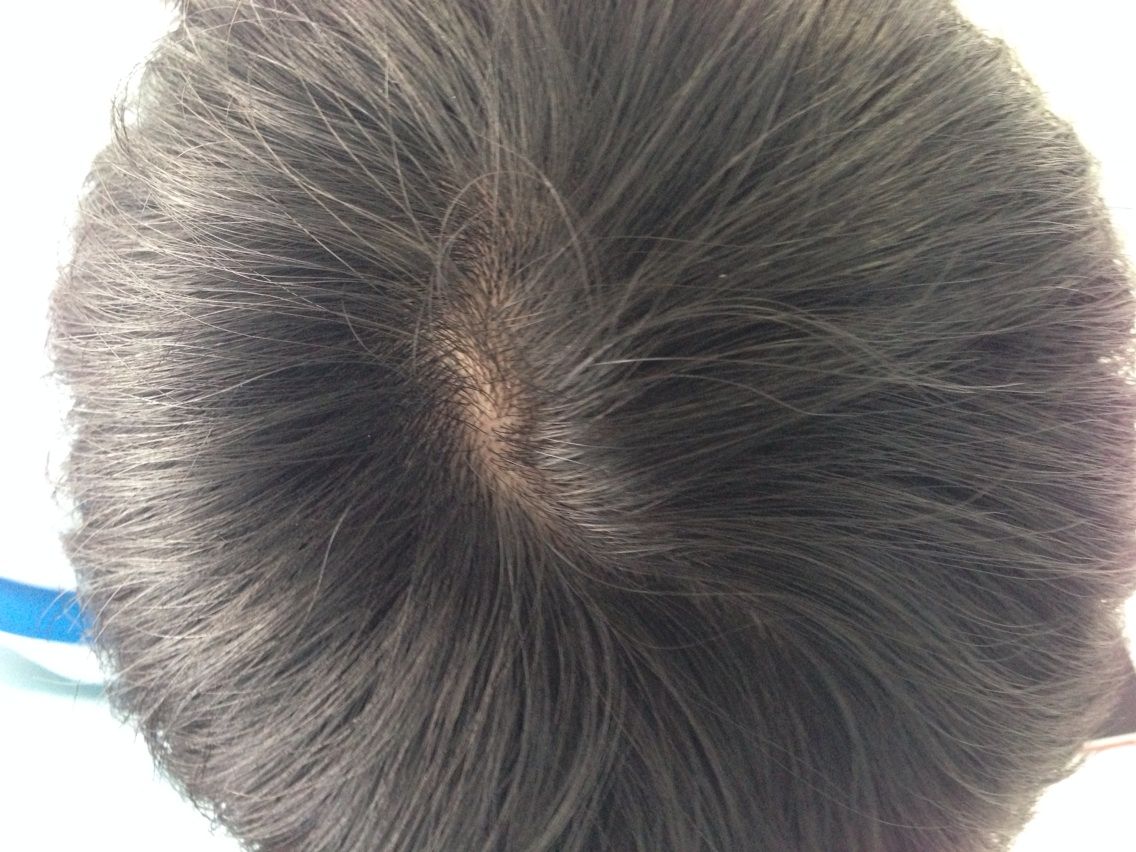 名つぞノの旋毛 つむじ と タクミのツムジ Dryoverhaulのblog