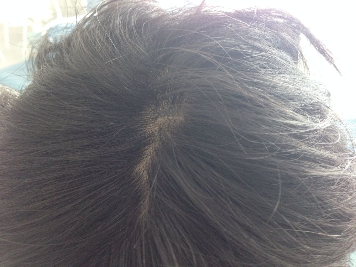 名つぞノの旋毛 つむじ と タクミのツムジ Dryoverhaulのblog