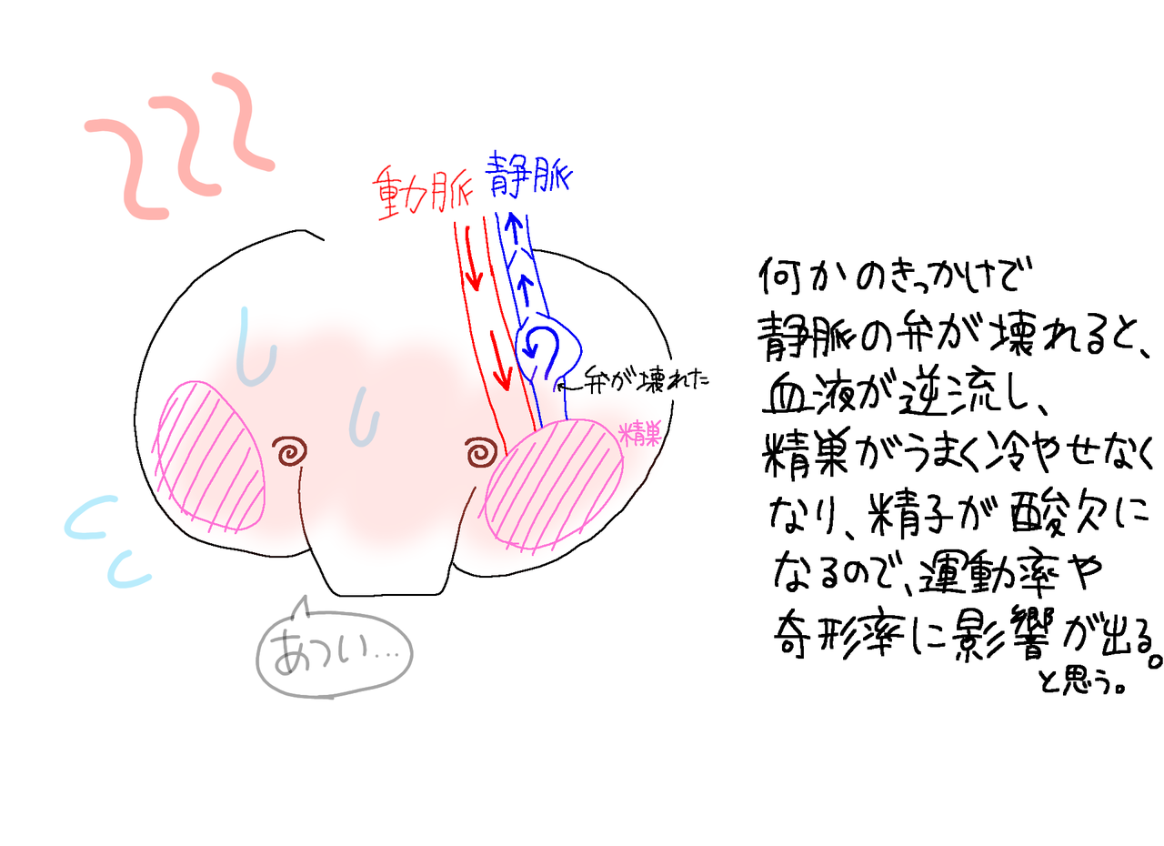 索 瘤 手術 静脈 精