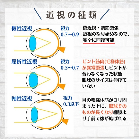 近視の種類