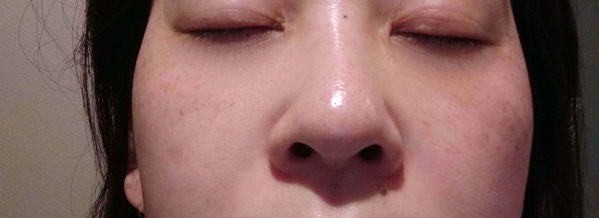 頬の肝斑が気になる37歳のつぶやき むっちり息子とガリガリ夫