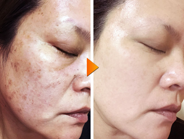 シミ消し 話題になっているeclas エクラス 薬用美容ジェルとは